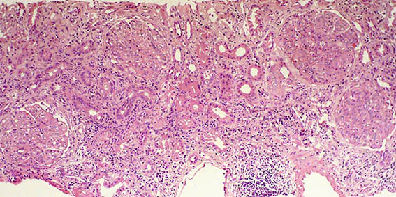 Hypernephroid Pattern 4 Nephrotic_Nephritic_Syndrome