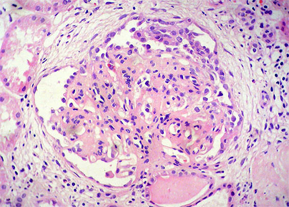 Hypernephroid Pattern 4 Nephrotic-Nephritic
