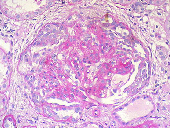 Hypernephroid Pattern 4 Nephrotic-Nephritic